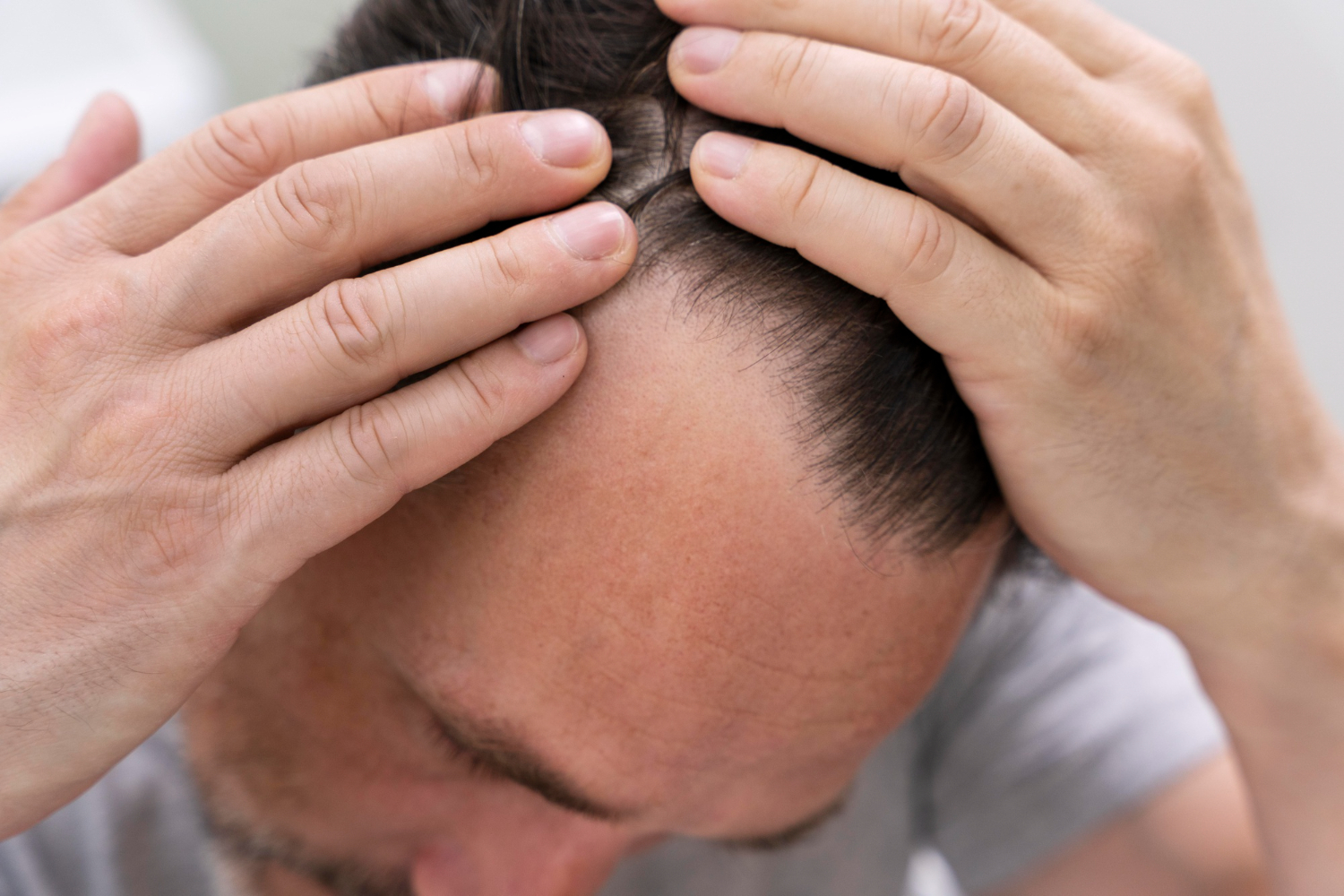 How Much Does a Hair Transplant Really Cost