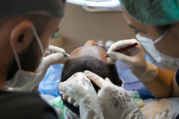 Which Hair Transplant Method Is Right for You