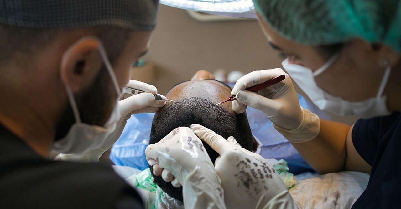 Which Hair Transplant Method Is Right for You