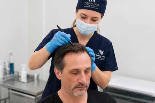 Hair transplant specialist at Turkish Hair Factory performing a scalp evaluation and hair restoration consultation before a personalized FUE or DHI hair transplant procedure in Tijuana, Mexico.